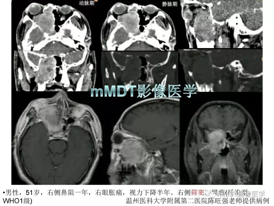 【PPT】脑膜肿瘤影像诊断1——脑膜瘤（脑膜上皮性）