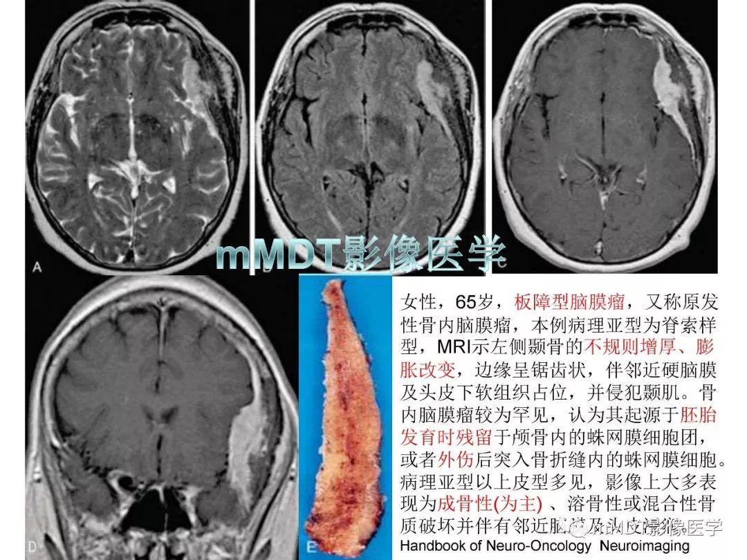 【PPT】脑膜肿瘤影像诊断1——脑膜瘤（脑膜上皮性）