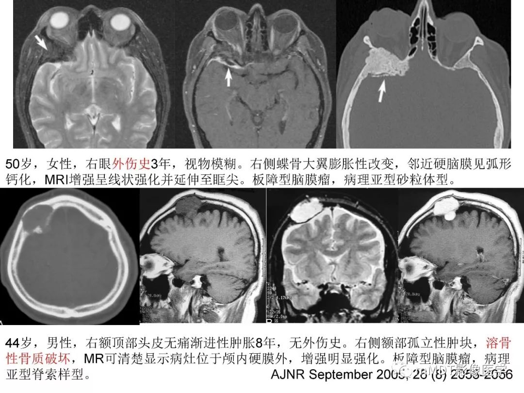 【PPT】脑膜肿瘤影像诊断1——脑膜瘤（脑膜上皮性）