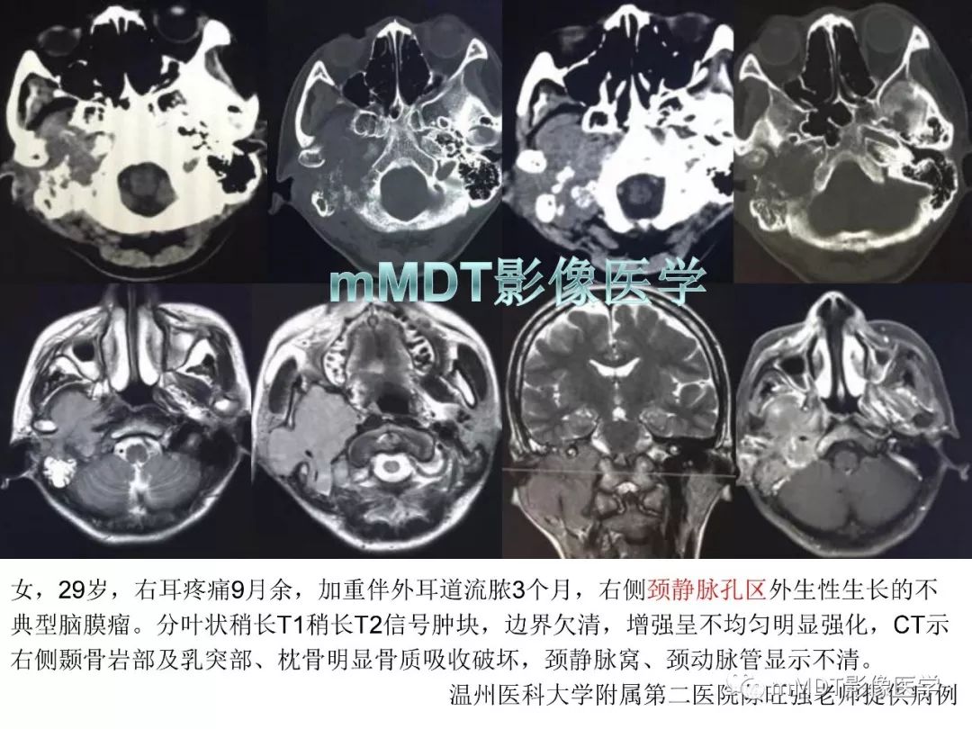 【PPT】脑膜肿瘤影像诊断1——脑膜瘤（脑膜上皮性）