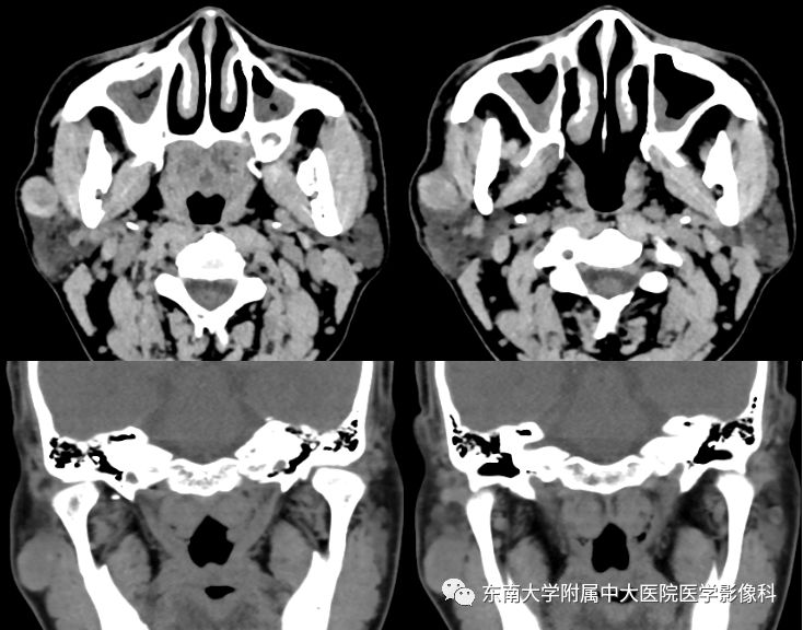 【病例】腮腺多形性腺瘤1例CT影像表现