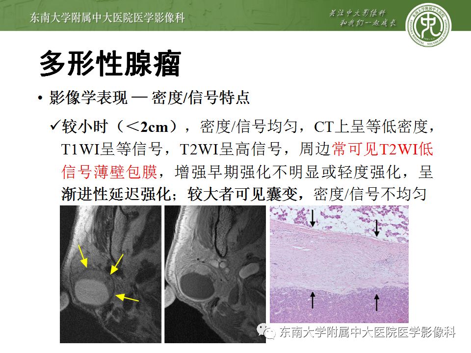 【病例】腮腺多形性腺瘤1例CT影像表现