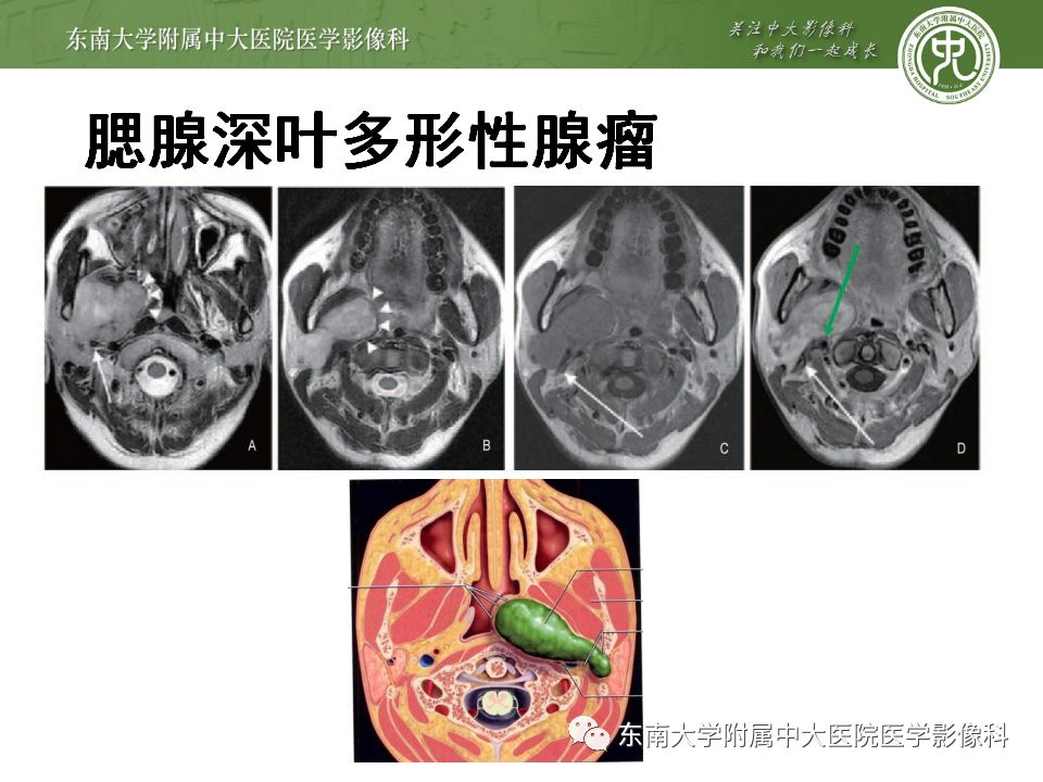 【病例】腮腺多形性腺瘤1例CT影像表现