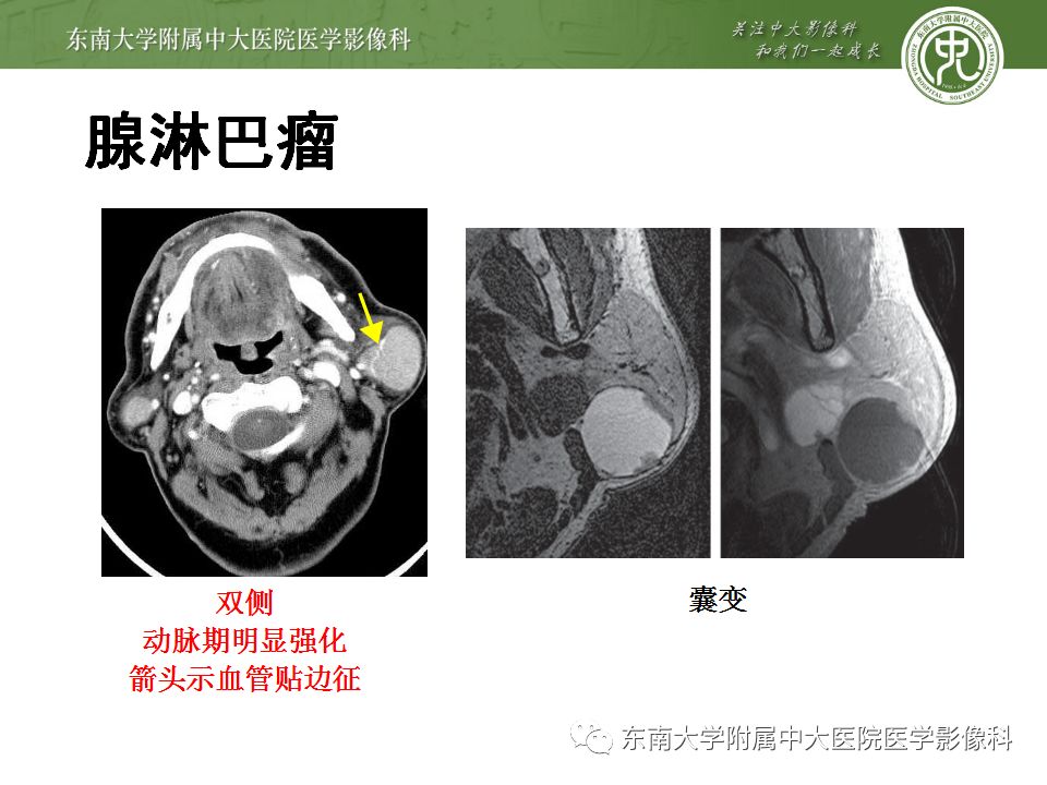 【病例】腮腺多形性腺瘤1例CT影像表现