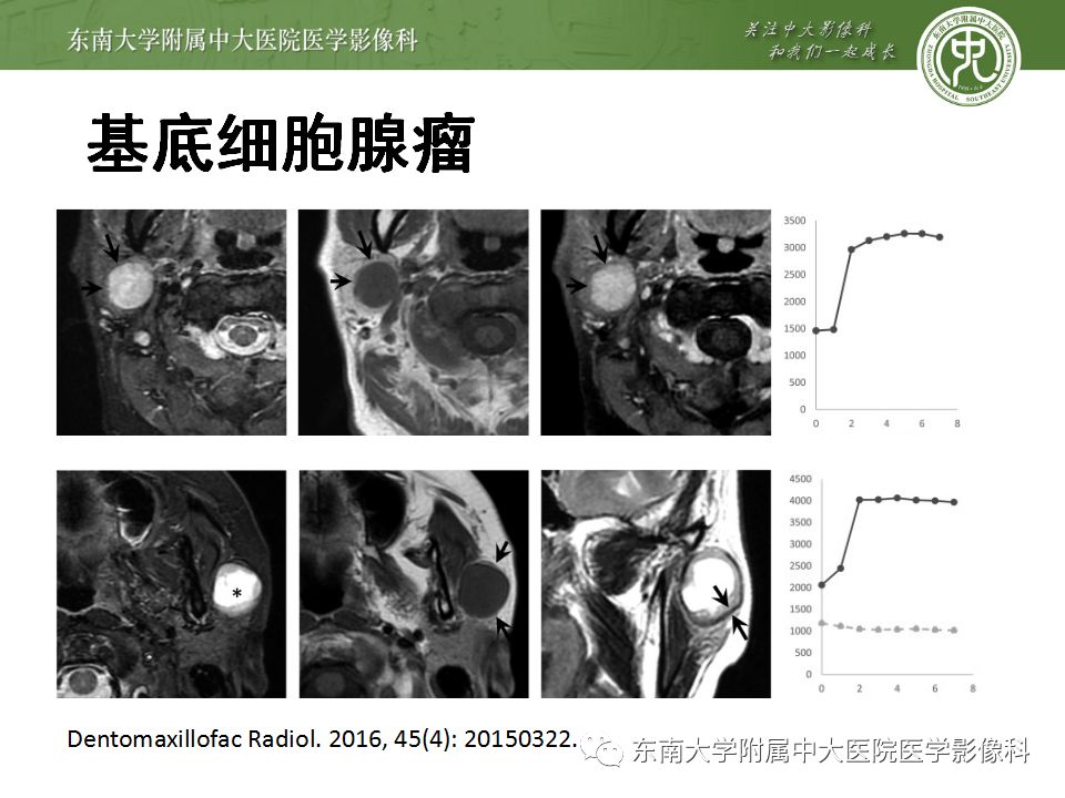 【病例】腮腺多形性腺瘤1例CT影像表现