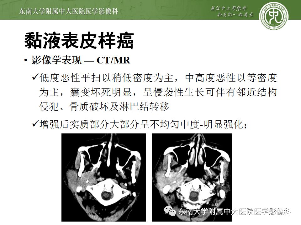 【病例】腮腺多形性腺瘤1例CT影像表现