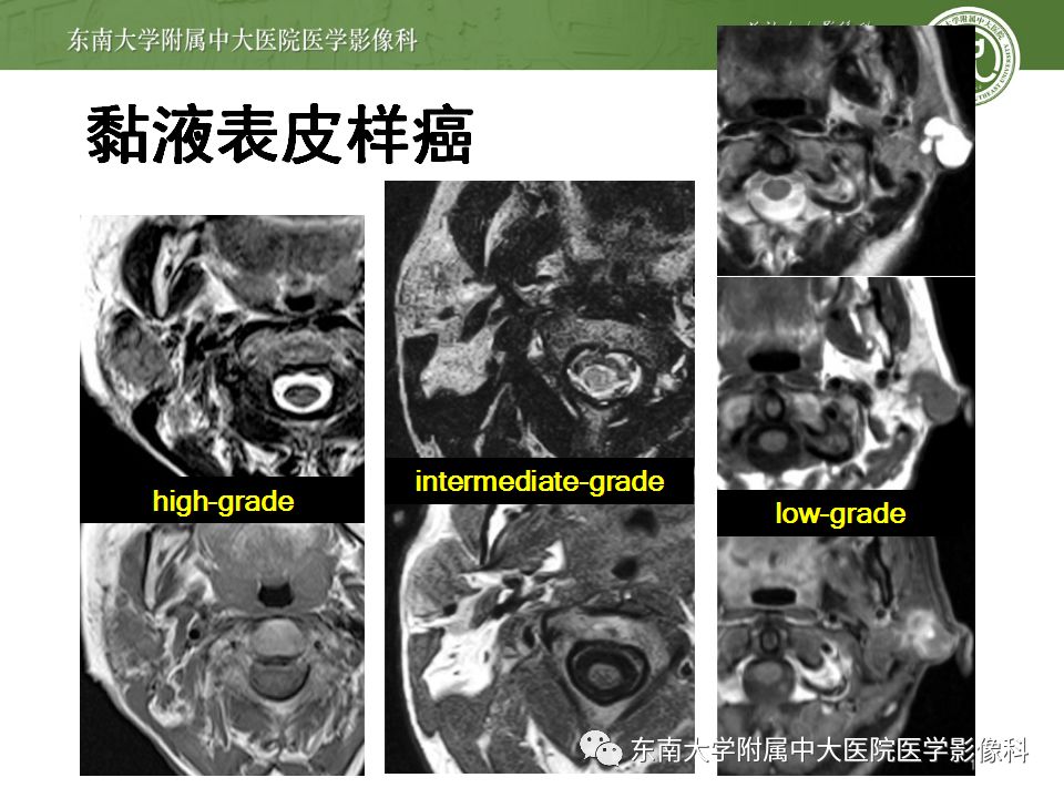 【病例】腮腺多形性腺瘤1例CT影像表现