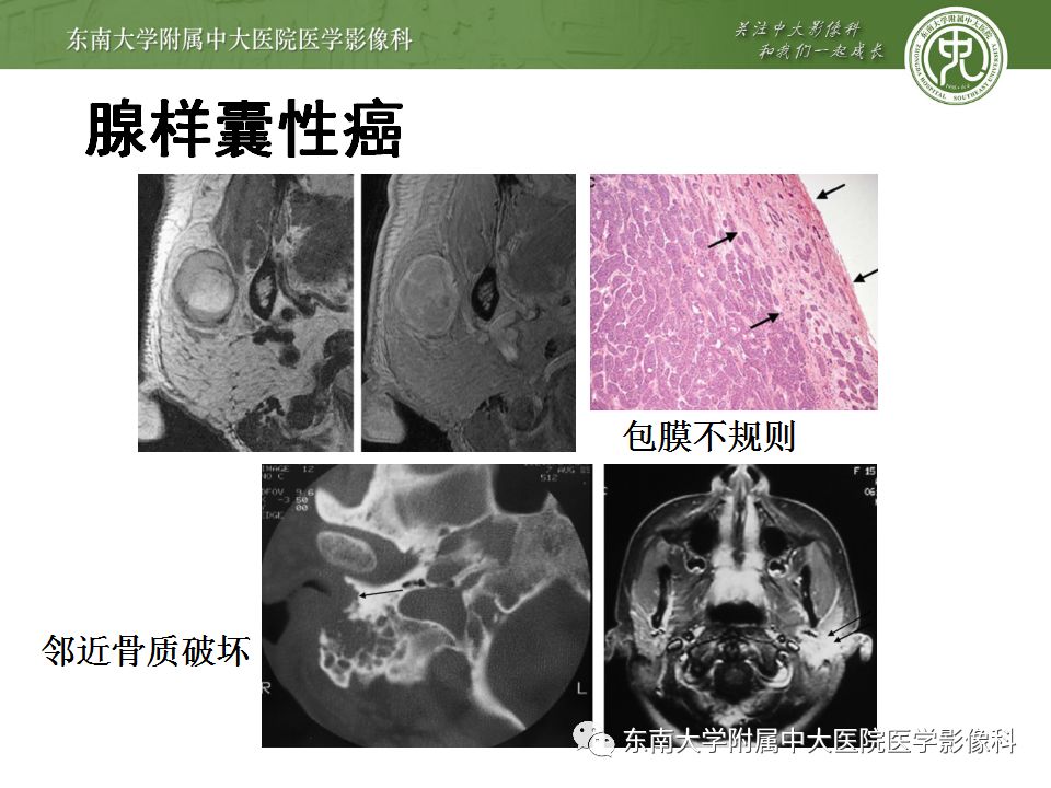 【病例】腮腺多形性腺瘤1例CT影像表现