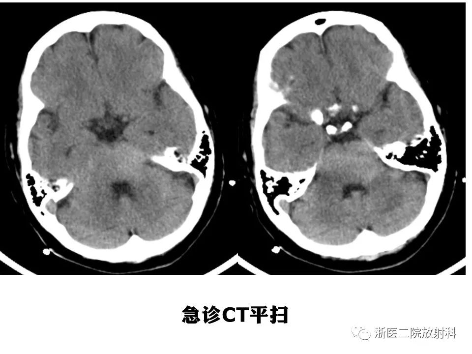 【病例】中枢神经系统白血病1例MR影像表现