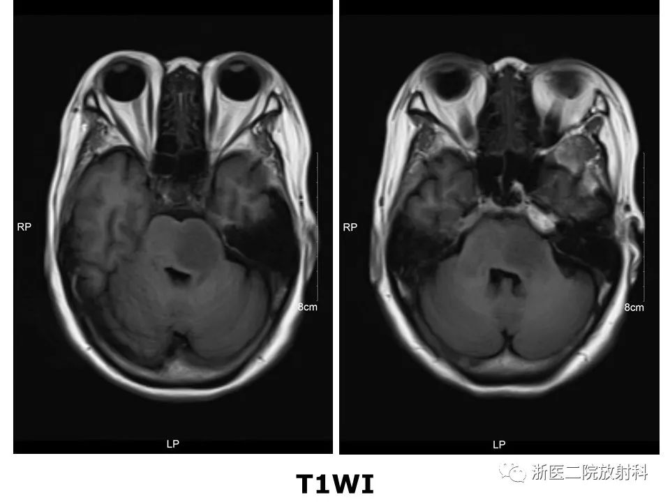 【病例】中枢神经系统白血病1例MR影像表现