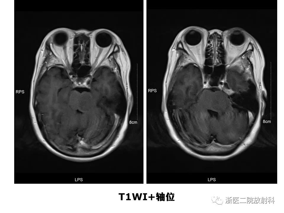 【病例】中枢神经系统白血病1例MR影像表现
