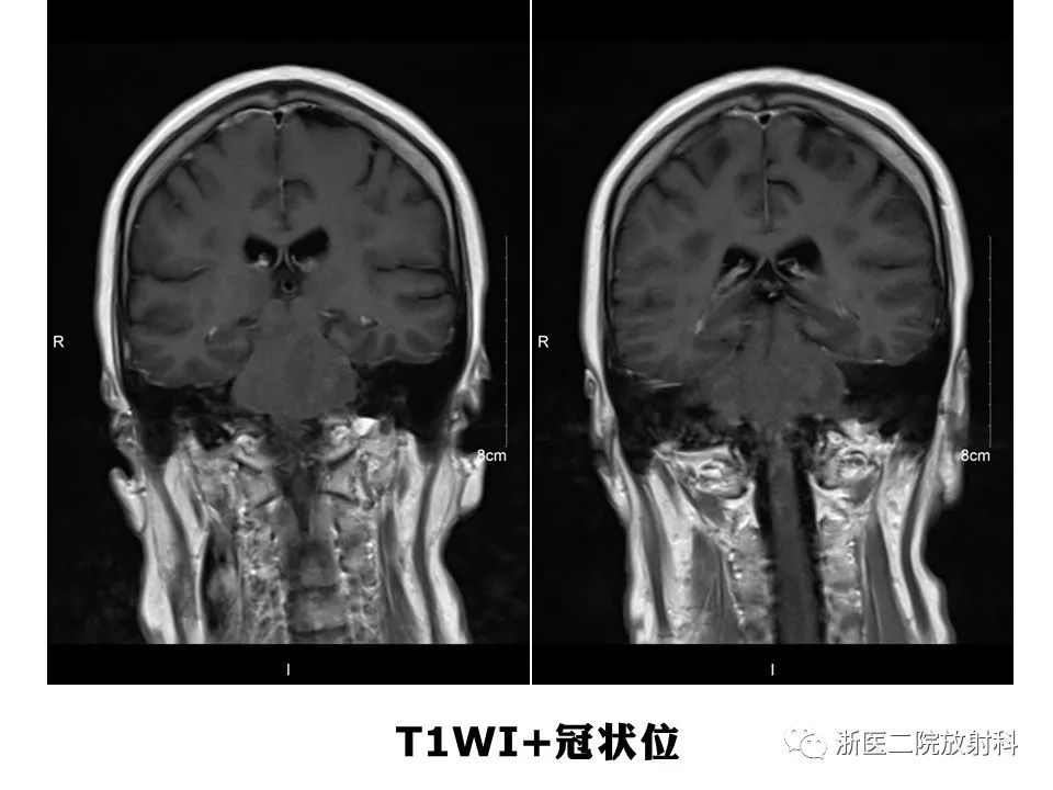 【病例】中枢神经系统白血病1例MR影像表现