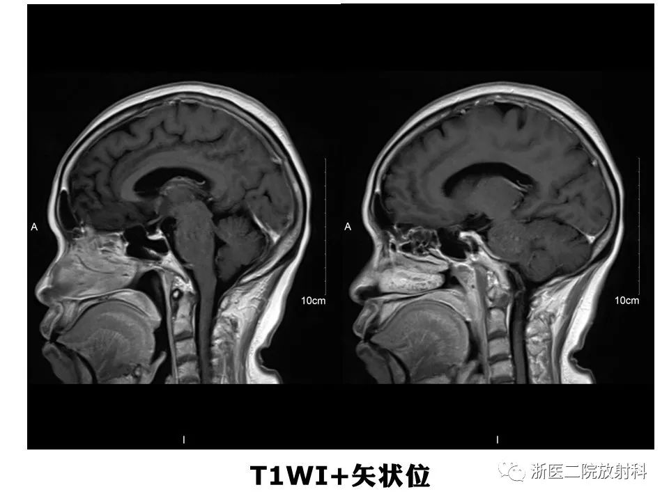 【病例】中枢神经系统白血病1例MR影像表现