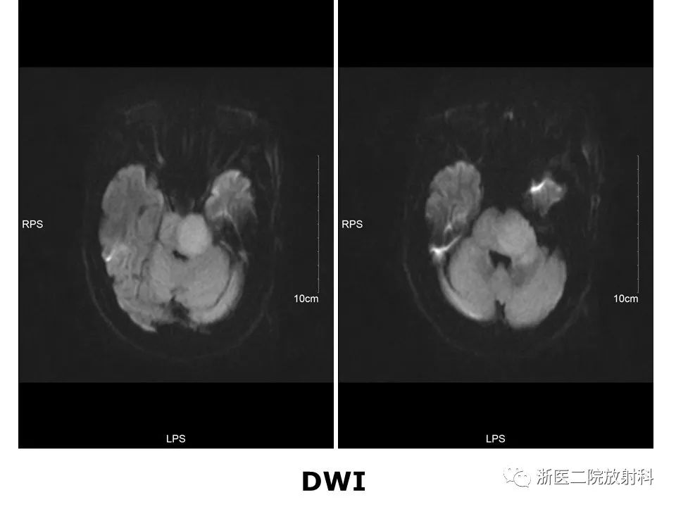 【病例】中枢神经系统白血病1例MR影像表现