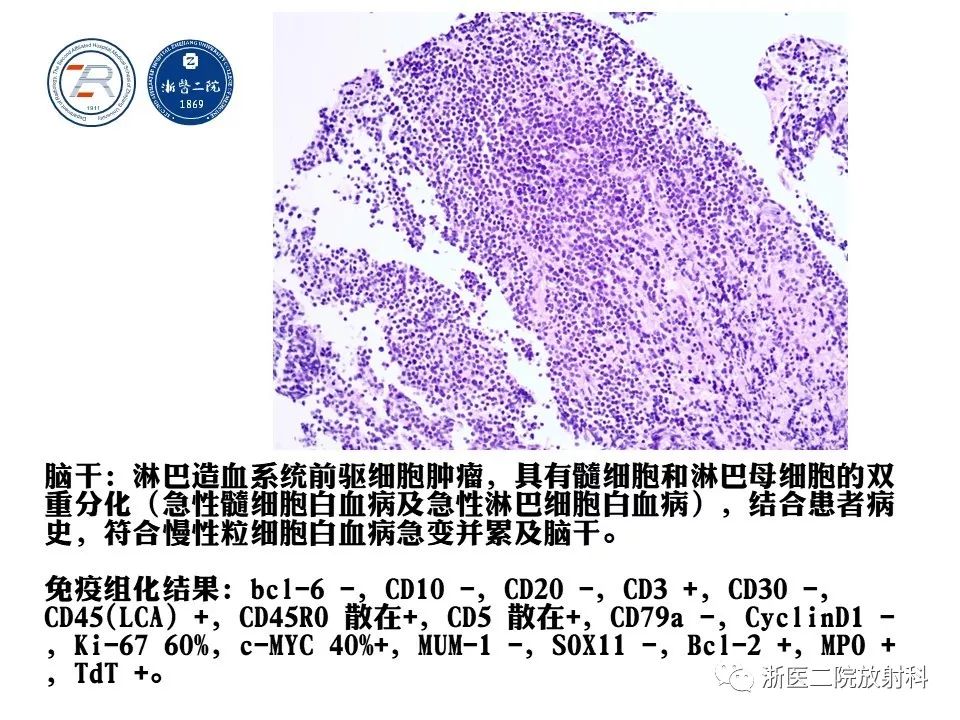 【病例】中枢神经系统白血病1例MR影像表现