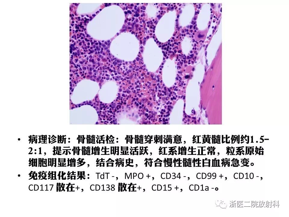 【病例】中枢神经系统白血病1例MR影像表现