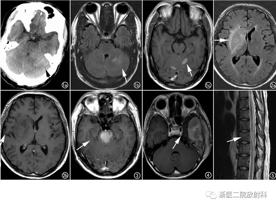 【病例】中枢神经系统白血病1例MR影像表现