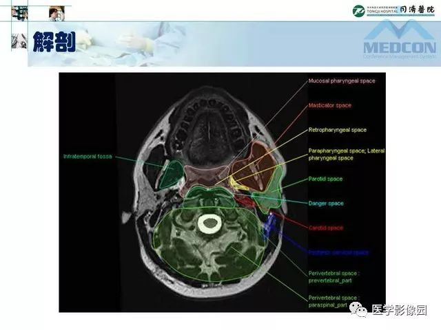 【PPT】腮腺肿瘤的MR诊断思路