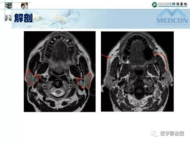 【PPT】腮腺肿瘤的MR诊断思路