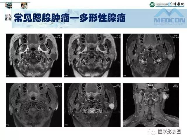 【PPT】腮腺肿瘤的MR诊断思路