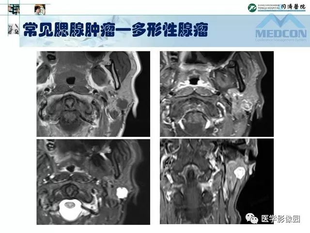 【PPT】腮腺肿瘤的MR诊断思路