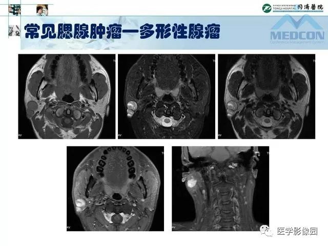 【PPT】腮腺肿瘤的MR诊断思路