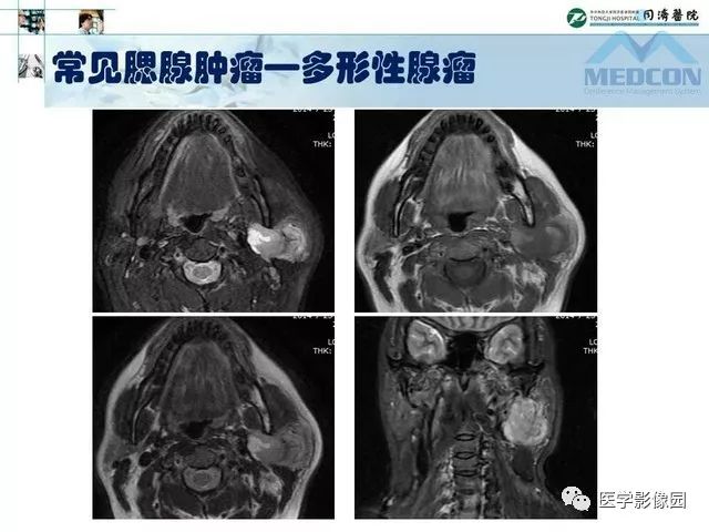 【PPT】腮腺肿瘤的MR诊断思路