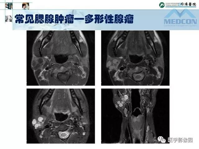 【PPT】腮腺肿瘤的MR诊断思路