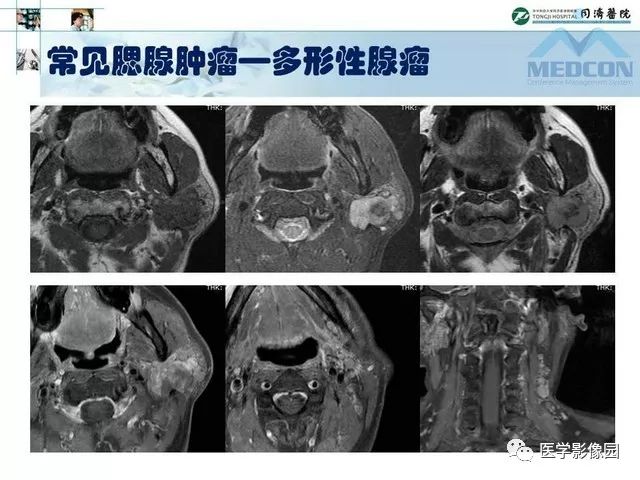【PPT】腮腺肿瘤的MR诊断思路