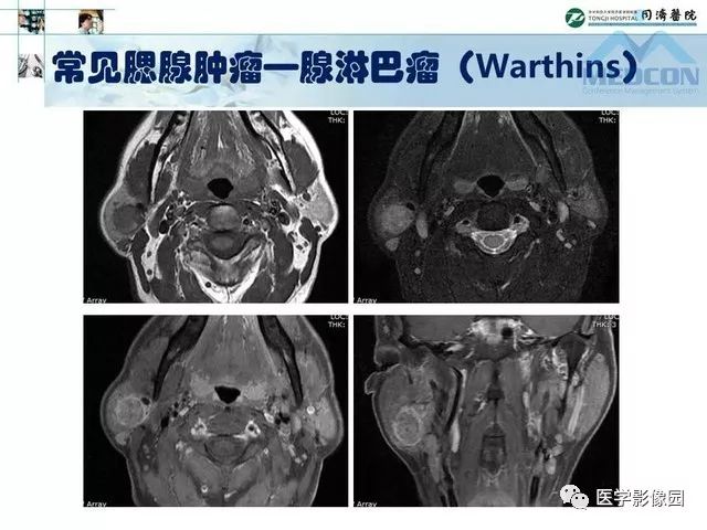 【PPT】腮腺肿瘤的MR诊断思路