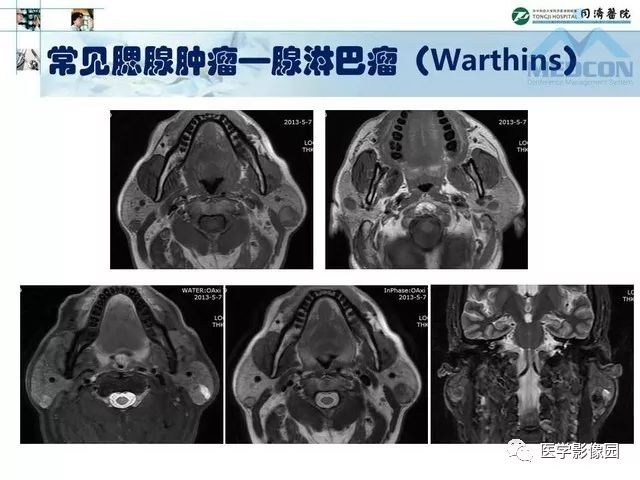 【PPT】腮腺肿瘤的MR诊断思路
