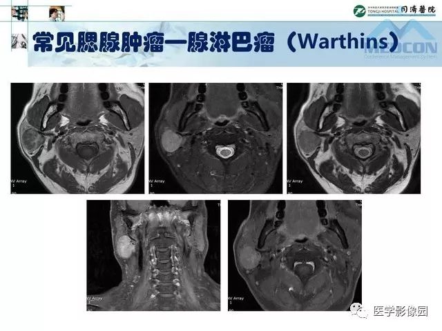 【PPT】腮腺肿瘤的MR诊断思路