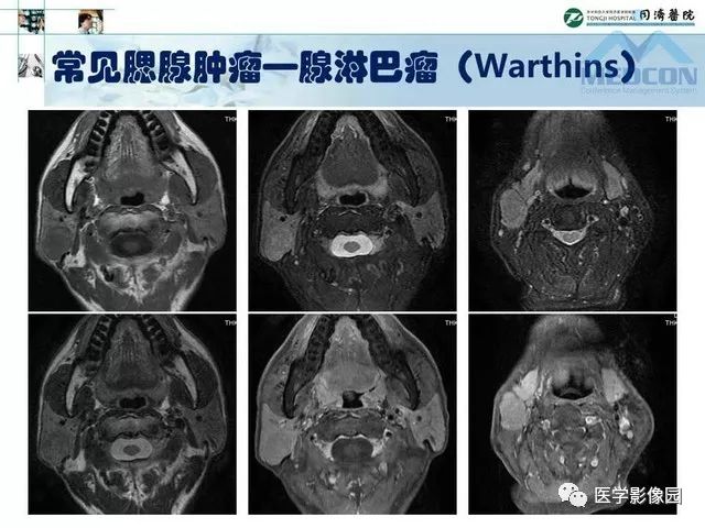 【PPT】腮腺肿瘤的MR诊断思路