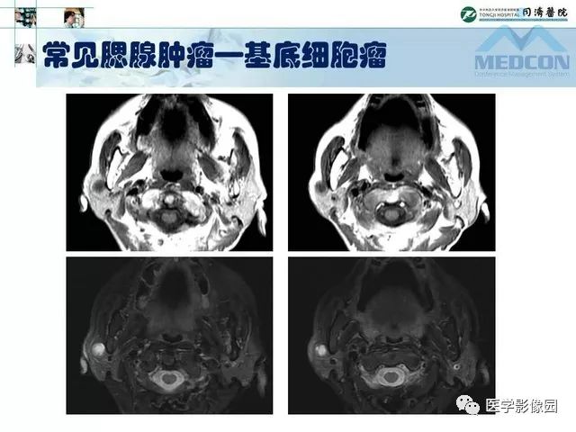 【PPT】腮腺肿瘤的MR诊断思路