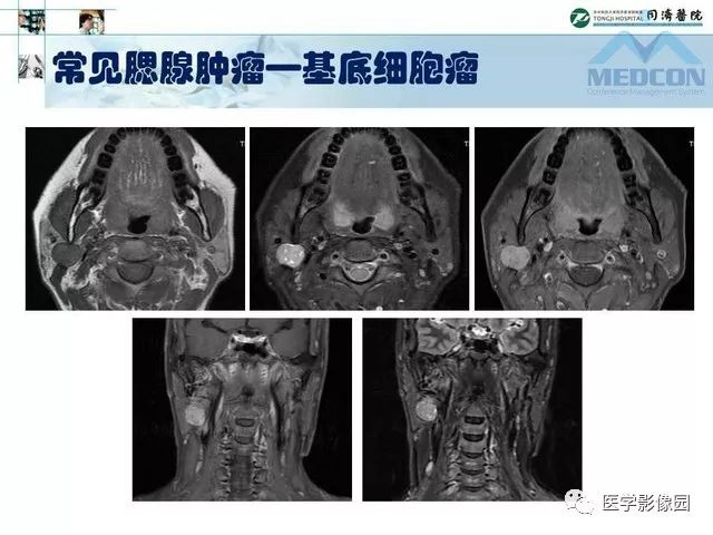 【PPT】腮腺肿瘤的MR诊断思路