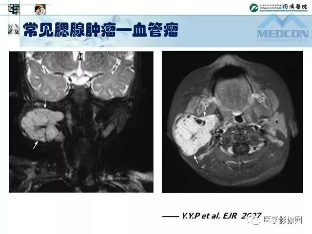 【PPT】腮腺肿瘤的MR诊断思路