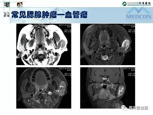 【PPT】腮腺肿瘤的MR诊断思路