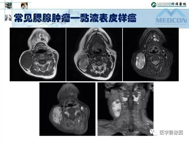 【PPT】腮腺肿瘤的MR诊断思路
