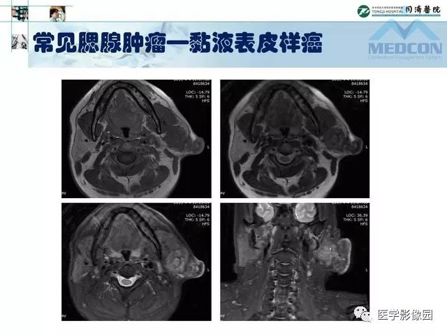 【PPT】腮腺肿瘤的MR诊断思路