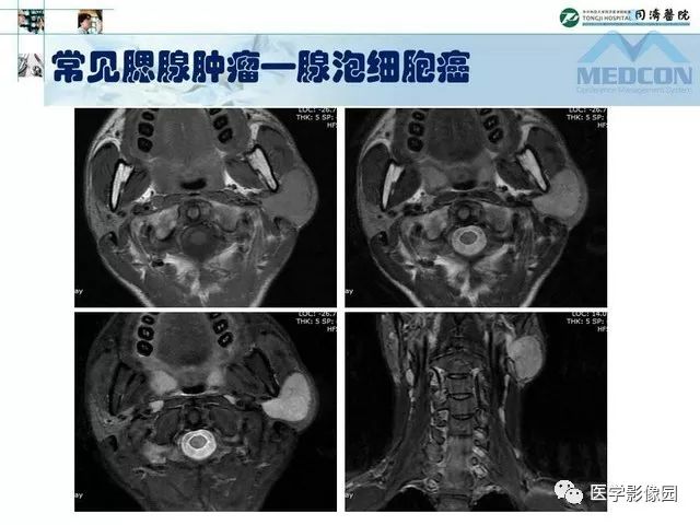【PPT】腮腺肿瘤的MR诊断思路