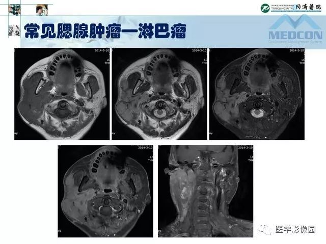 【PPT】腮腺肿瘤的MR诊断思路