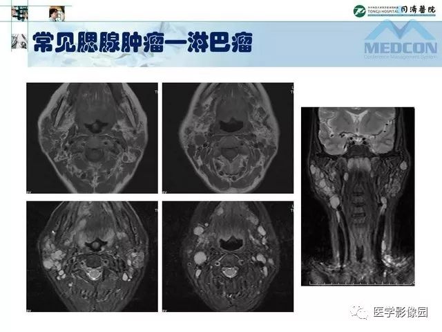 【PPT】腮腺肿瘤的MR诊断思路
