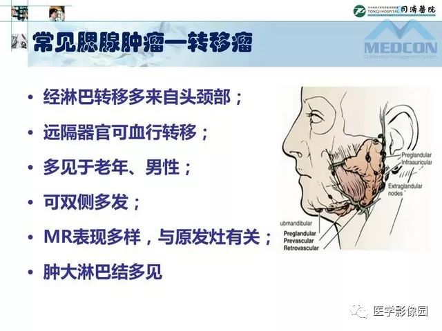 【PPT】腮腺肿瘤的MR诊断思路