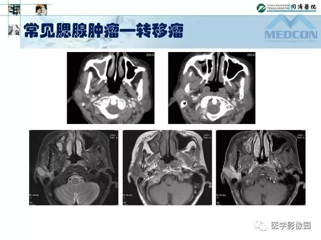 【PPT】腮腺肿瘤的MR诊断思路