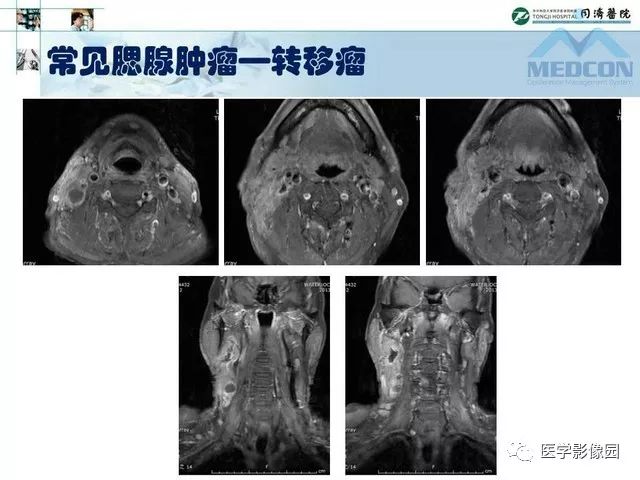 【PPT】腮腺肿瘤的MR诊断思路