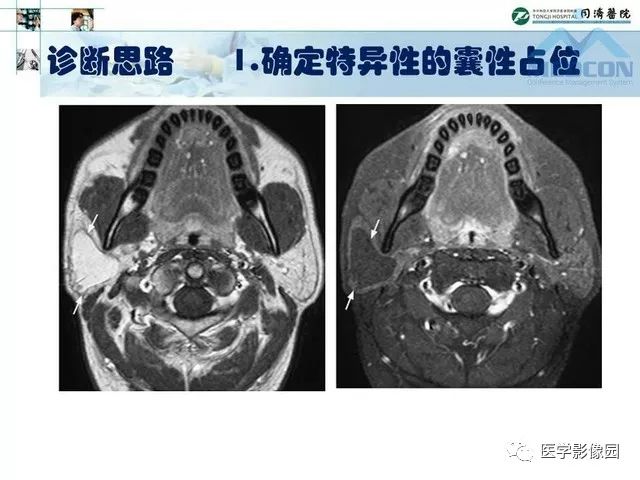【PPT】腮腺肿瘤的MR诊断思路