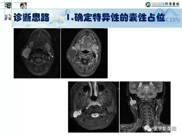 【PPT】腮腺肿瘤的MR诊断思路