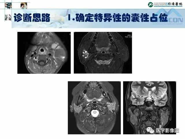 【PPT】腮腺肿瘤的MR诊断思路