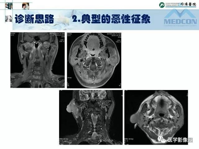 【PPT】腮腺肿瘤的MR诊断思路