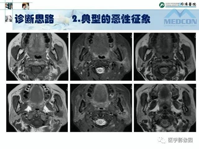 【PPT】腮腺肿瘤的MR诊断思路
